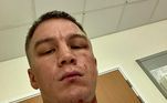 Kotochigov mostrou a seriedade da lesão em suas redes sociais. Além das fotos, o boxeador contou em detalhes o que teria acontecido em uma publicação no Instagram