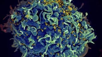 53-year-old man is the fifth patient cured of HIV after stem cell transplant – News