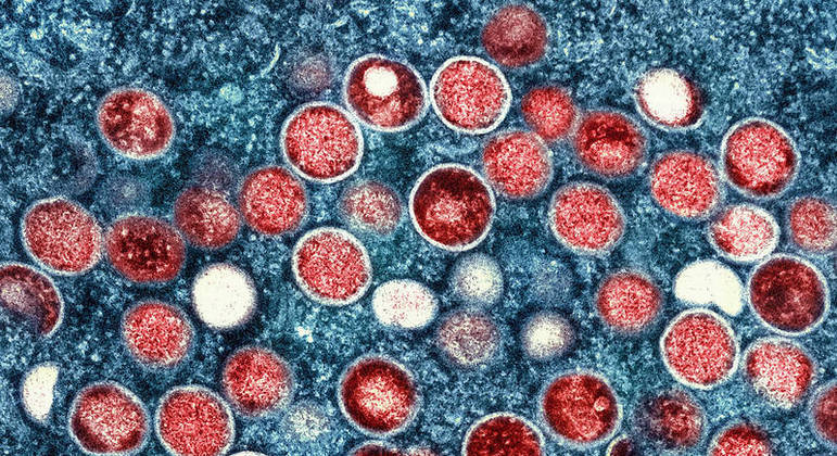 Este é o maior surto já registrado de vírus monkeypox