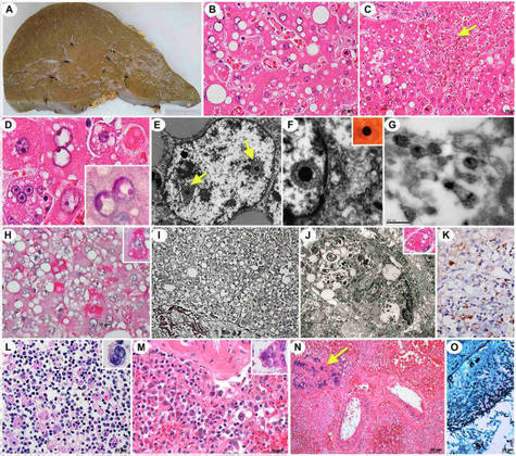 A doença é transmitida pelo vírus Sabiá, um mammarenavirus, identificado pela primeira vez em 1990, na Grande São Paulo. Ele é transmitido a partir da inalação ou ingestão de urina ou fezes de roedores selvagens que estejam infectados. O baixo número de casos faz com que pesquisadores tenham até hoje pouco conhecimento de mais detalhes da febre hemorrágica brasileira