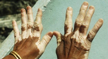 Vitiligo não impõe limitação física ou cognitiva