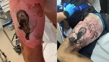Vítima expõe queimaduras após explosão de cigarro eletrônico