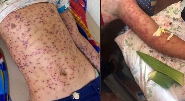 Vítimas foram picadas diversas vezes em ataque de abelhas-africanas