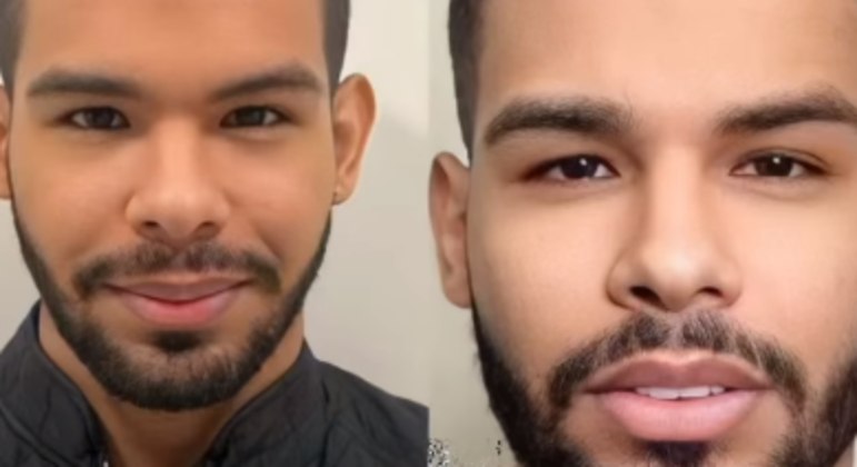 Vyni antes e depois da harmonização facial