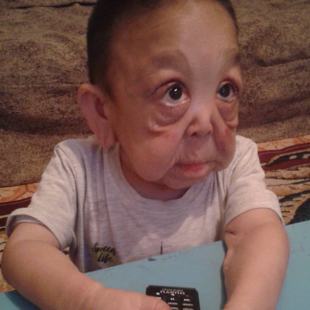 Benjamin Button Doenca Rara Faz Menino De 6 Anos Ter Cara De Idoso Fotos R7 Hora 7