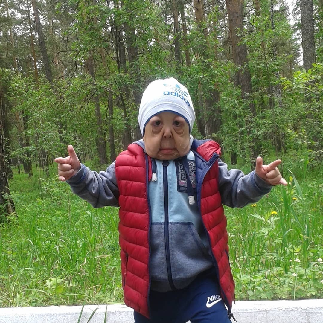 Benjamin Button Doenca Rara Faz Menino De 6 Anos Ter Cara De Idoso Fotos R7 Hora 7