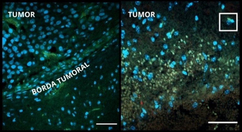 À esquerda, borda de tumor não tratado e, à direita, borda de tumor que recebeu zika